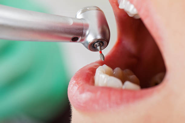 Best Dentist for Tooth Abscess  in West Springfield, VA